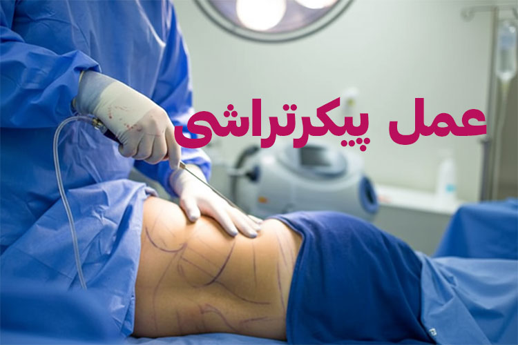 عمل پیکرتراشی عمل پیکرتراشی