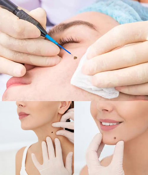 برداشتن-خال-3 برداشتن انواع خال