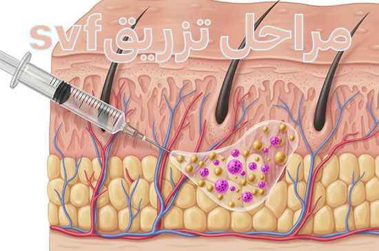 مراحل انجام تزریق svf چربی برای جوانسازی پوست