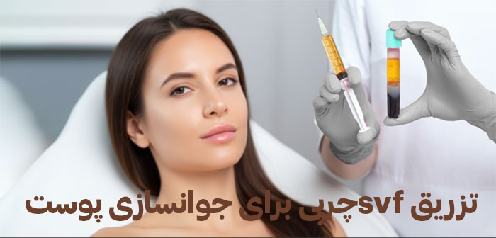 تزریق-svf