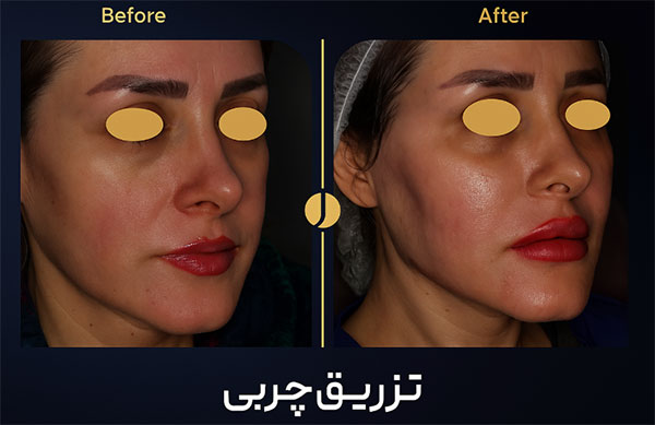 تزریق-چربی تزریق-چربی