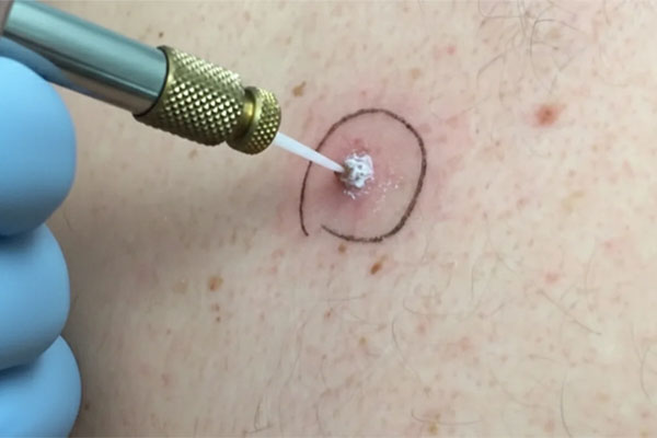 درمان زگیل ها و ضایعات خوش خیم پوستی