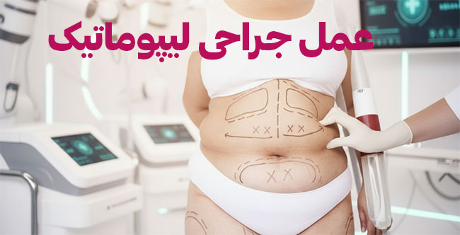 عمل-جراحی-لیپوماتیک لیپوماتیک