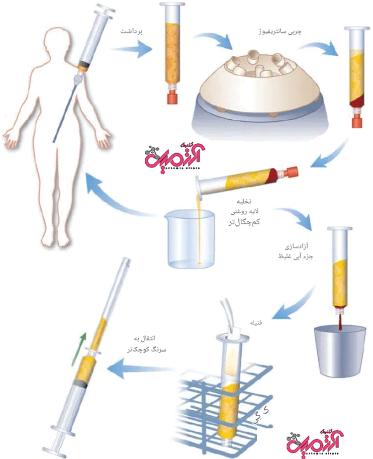 تزریق چربی چیست و چگونه انجام می‌شود؟