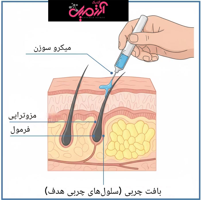 مزوتراپی مو چیست و چگونه عمل می‌کند؟