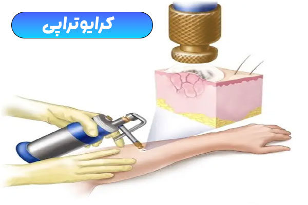 تعریف علمی کرایوتراپی