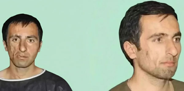 تزریق SVF به  شقیقه