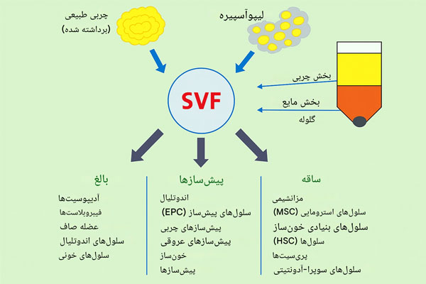 تزریق SVF زیر چشم چیست ؟، رفع تیرگی زیر چشم 