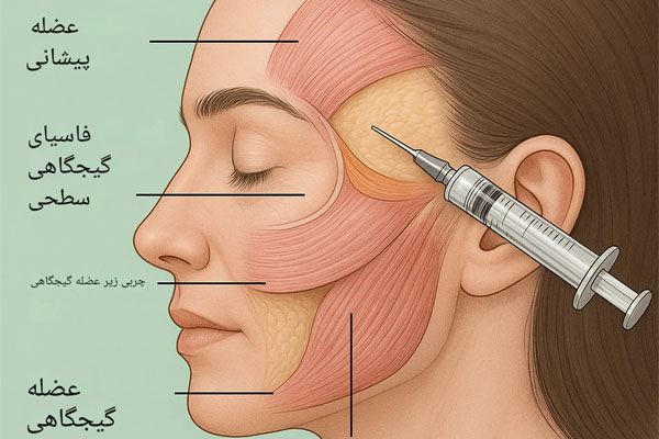 تزریق SVF به شقیقه 