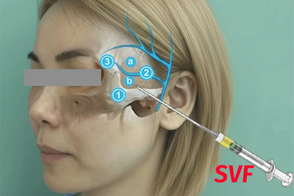 تزریق SVF شقیقه