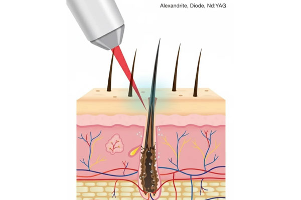 عملکرد دستگاه‌های لیزر صورت