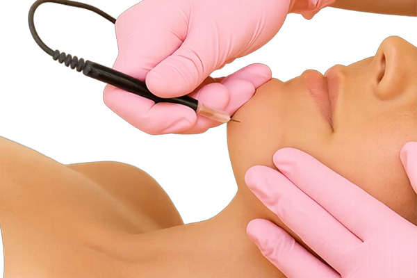 اکترولیز موهای زائد