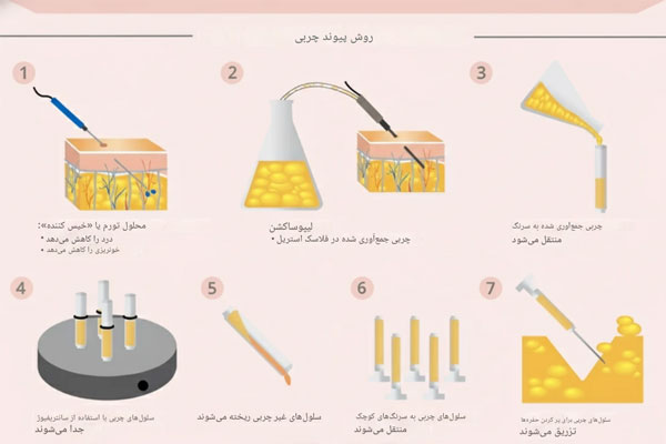 تزریق SVF به پیشانی
