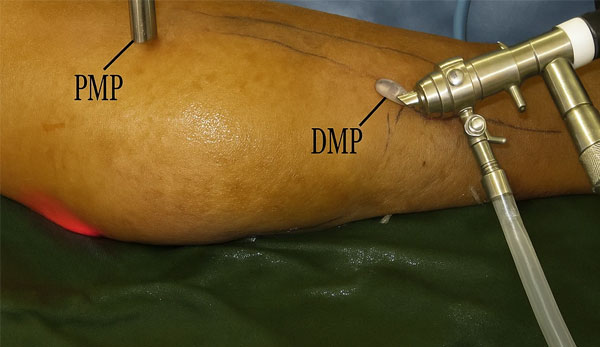 جراحی لیپوم  ، Lipoma surgery