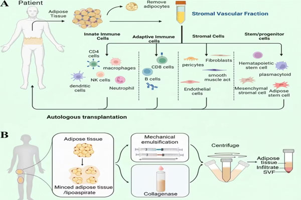 سلول درمانی SVF