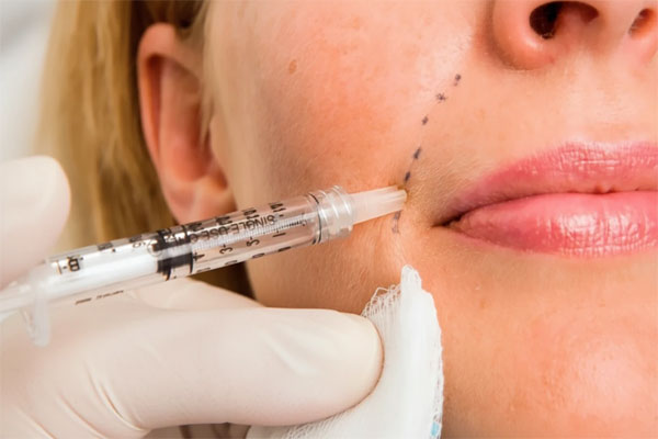 فیلر-خط-لبخنده-شاخص فیلر خط خنده