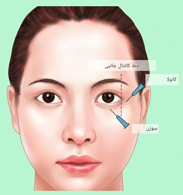 فیلر-زیر-چشم-001 فیلر زیر چشم