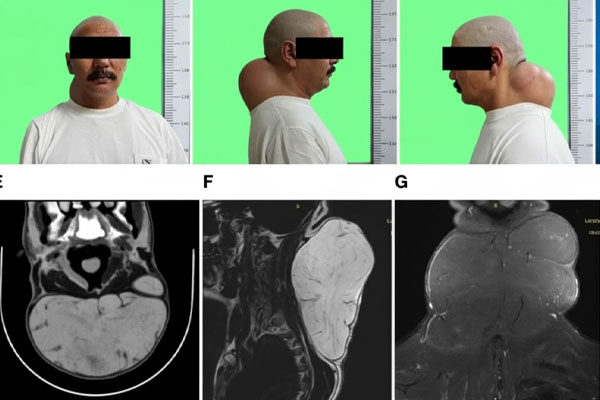 درمان لیپوم