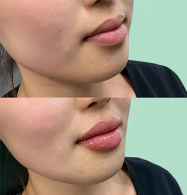مزایا-و-کاربردهای-زیبایی-svf-لب تزریق SVF لب