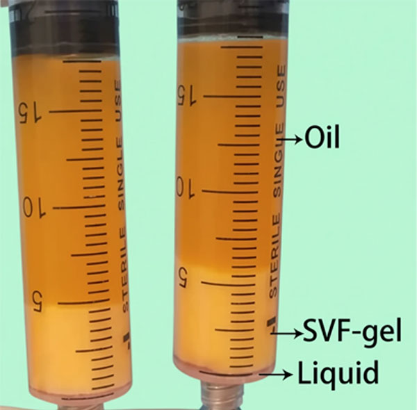 تزریق SVF خط خنده