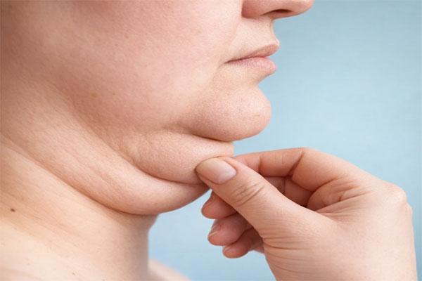 مزو تراپی غبغب