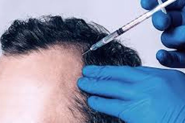 مراحل تزریق فیلر مو